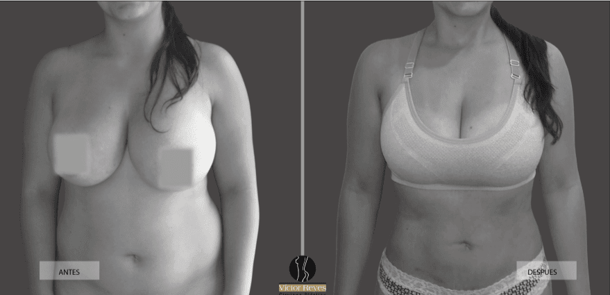 Ejemplo Liposucción Pereira - Dr. Víctor Reyes