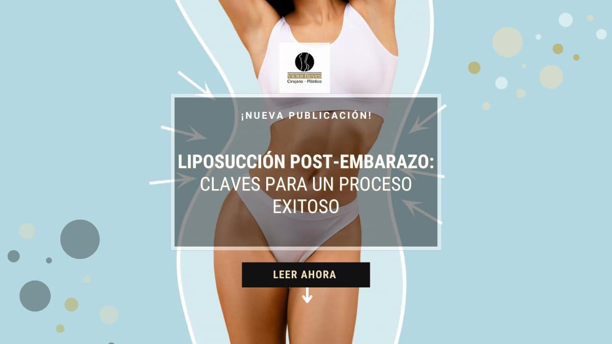 Liposucción Post-Embarazo: claves para un proceso exitosa