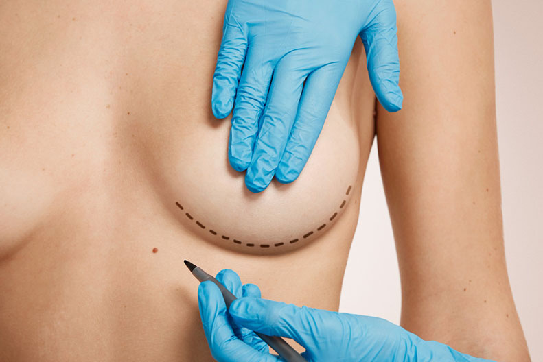 Mastopexia cirugía plástica estética en Pereira