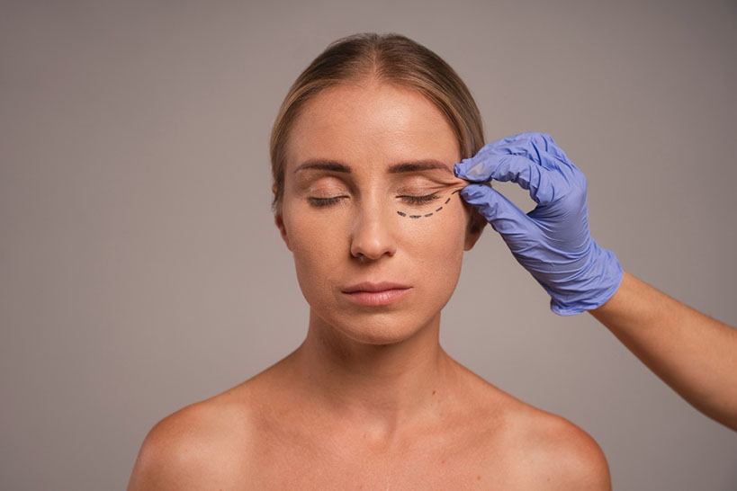 Blefaroplastia - cirugía de párpados en Pereira