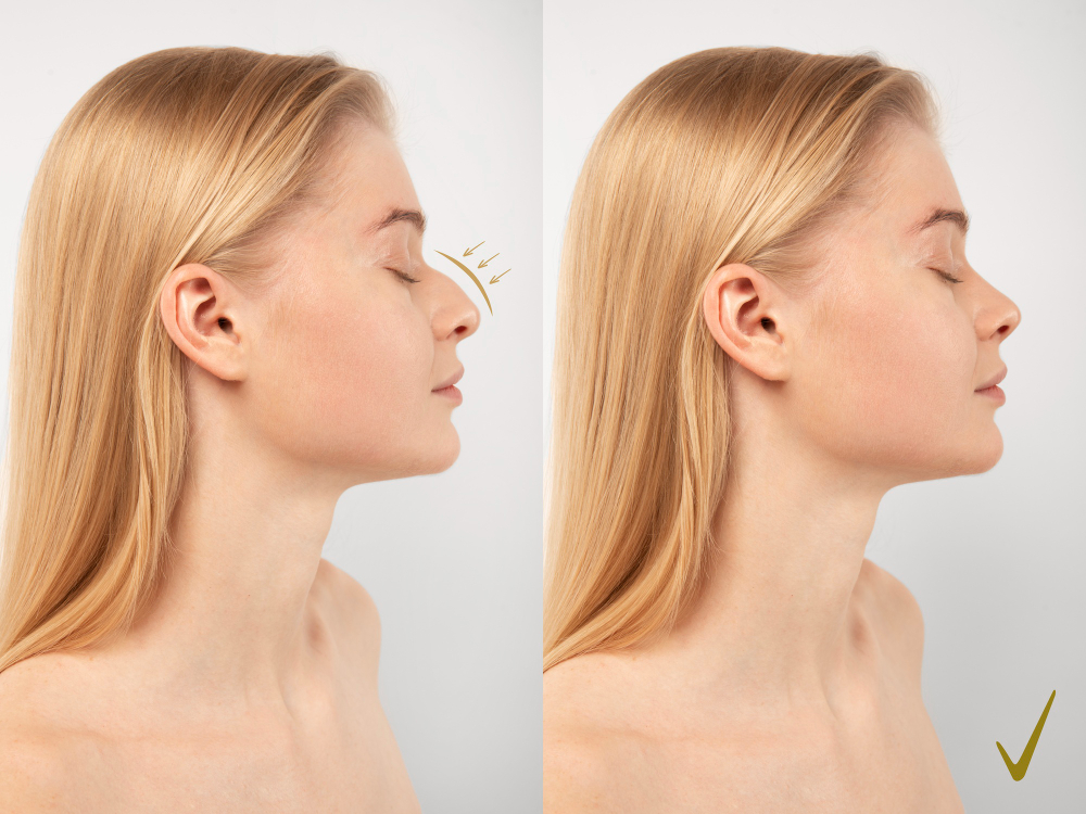 Rinoplastia-antes-después cirugía plástica estética en Pereira